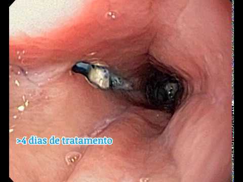 Para que se hace una endoscopia digestiva alta