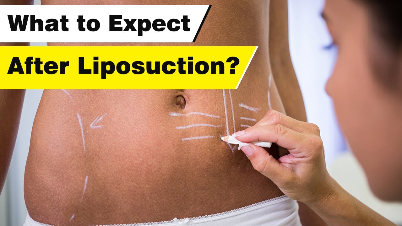What Results To Expect After Liposuction? | When Will You See Your Liposuction Final Results?