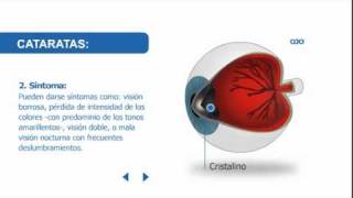 Cataratas en los ojos: síntomas y tratamiento | Baviera antes Clínica Baviera