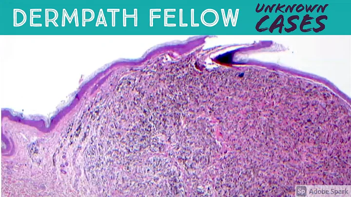 Dermpath Fellow Unknown Cases! Filler reaction, large B-cell lymphoma, radiation dermatitis, & more