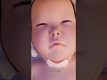 WHY DO THEY PUT TAPE ON BABYS EYES!? YOU'LL BE SHOCKED #baby  #chinese #tape #bpessyndrome