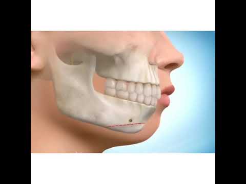 نحوه انجام جراحی چانه و فک