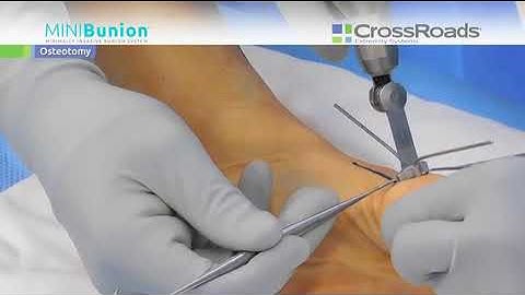 MINIBunion™: MIS Bunion System - Surgical Case - Dr. Bradley Lamm