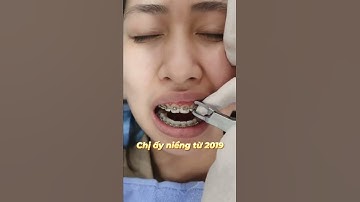 Tháo Niềng Hàm Trên | Tháo Mắc Cài Hàm Trên | Tháo Niềng Răng #thaonieng #thaoniengrang #niengrang