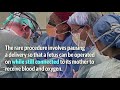 UW Medical Center Surgeons Perform Rare Mid-Birth Surgery To Save nNewborn
