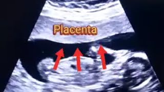 Anterior Placenta with baby Boy | Posterior Placenta with baby Girl | Baby genders and 3 vessel cord