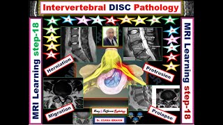 Intervertebral Disc Pathology (MRI learning; Episode- 18)