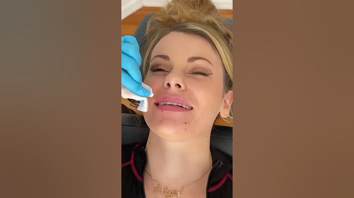 Lip Filler at Coco Med Spa in St. Pete