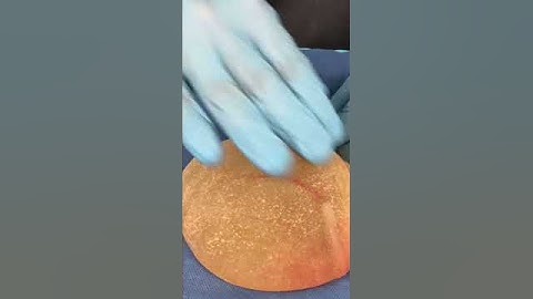 😮Dr.Castañeda and 20 years old implants removed #plasticsurgeon #breastimplants #surgery #implant