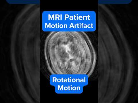 MRI Rotational Motion Artifact – Why It Happens and How to Fix It