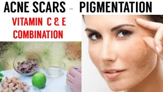 Pigmentation darkspot acne scars removal remedy by beauty with knowledge|get rid of pigmentation