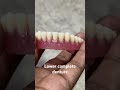 Lower complete denture 😬😬😬#apexdental #splittooth #dentistry #partialdenture #orthodontist