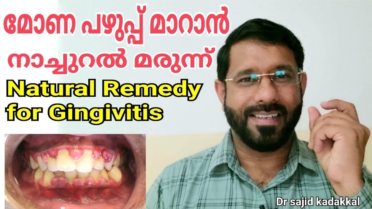 Natural Remedy for Gingivitis,  മോണ വീക്ക മാറാൻ ഫലപ്രദമായ പ്രകൃതിദത്ത മരുന്ന്.