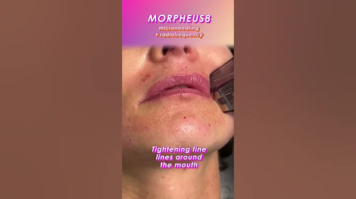 Tightening Skin around Mouth - Morpheus8 Microneedling | New Skin Laser #shorts