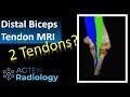 Distal Biceps Tendon Ruptur on MRI