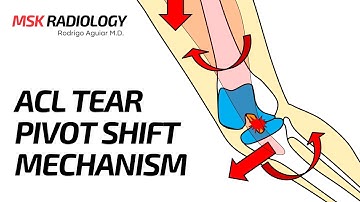 Pivot Shift Mechanism of ACL tear - How the MRI Bone Marrow Edema Occurs