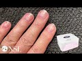 Introduction to the NSI Soft Gel Tip System