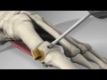 First metatarsal distal chevron osteotomy with arthrex lps screw