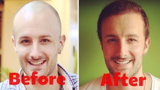 The History Of Hair Restoration Surgery, & why we're scared of