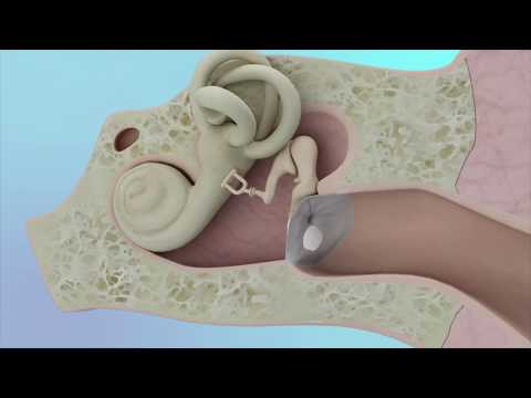 Хирургия горла Eardrum - Трансканальная тимпанопластика