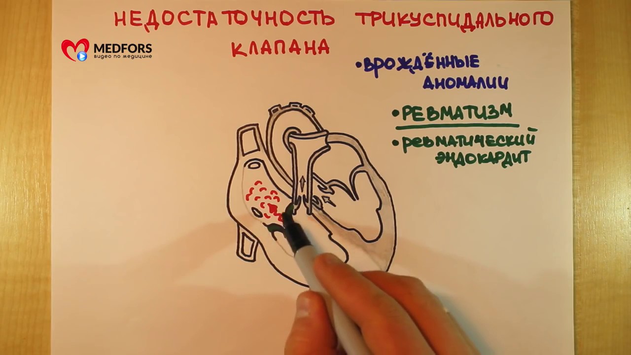 Недостаточность тк клапана