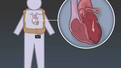 A Trial of a Wearable Cardioverter-Defibrillator after Myocardial Infarction