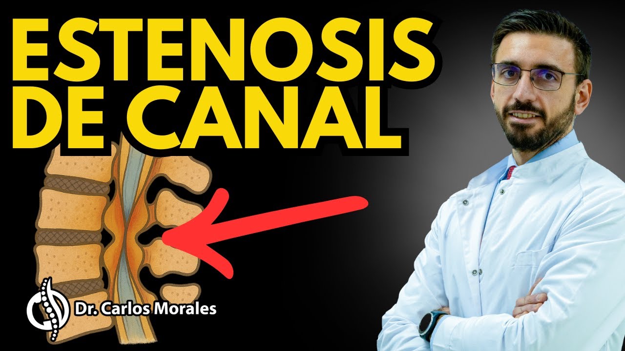 👨‍⚕️ Todo lo Que Necesitas Saber Sobre la Estenosis de Canal | Dr. Carlos Morales