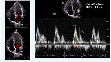 diastolic dysfunction part I - concept & measurement