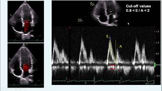 diastolic dysfunction part I - concept & measurement