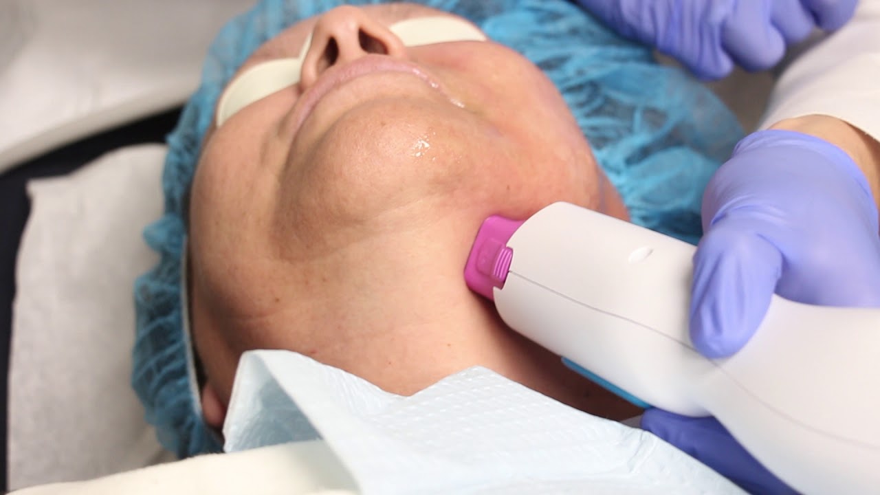 Banner for New Thermage FLX for Smooth Skin on the Face