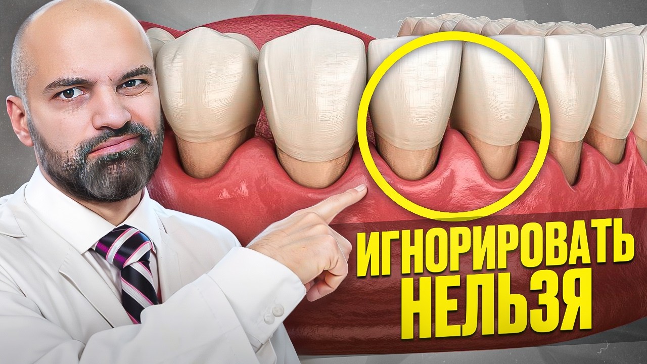 Опущение Десны Закончится ПЛОХО | Что такое Рецессия Десны и КАК её Остановить