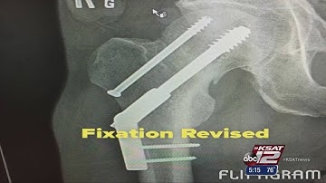 Video: San Antonio man running again after natural hip replacement