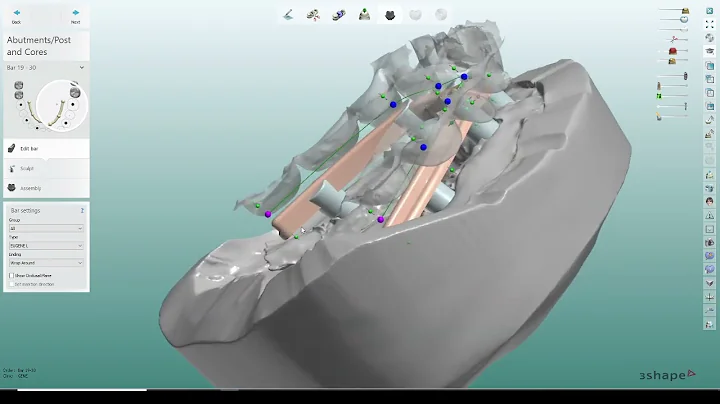 Hybrid denture bar view with basal surface scan