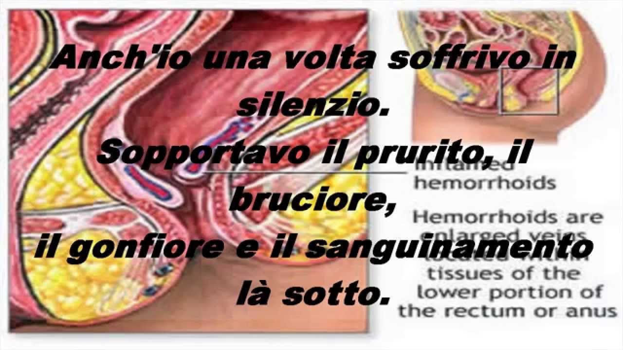 Gravidanza di emorroidi di patate