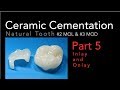 Ceramic Cementation, Part 5