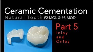 Lithium Disilicate Ceramics, Part  5: Cementation of Inlay and Onlay