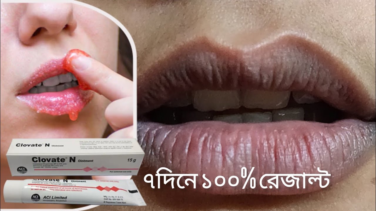 ঠোঁটের কালো দাগ ও মুখের কালো দাগ রিমুভ করার ভয়ংকর ক্রিম। Clovate n ointment.