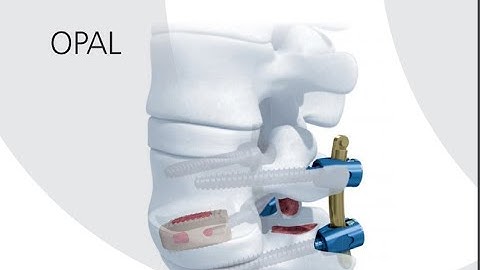 DepuySynthes (Synthes): OPAL Animation