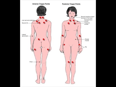 Fibromialgia puntos dolorosos