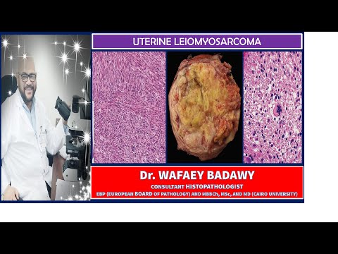 UTERINE LEIOMYOSARCOMA BY Dr WAFAEY BADAWY