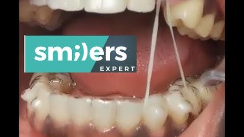 Maximum Anchorage With Bioformed attachment and Strong plastic from Smilers R D www.smilers.com