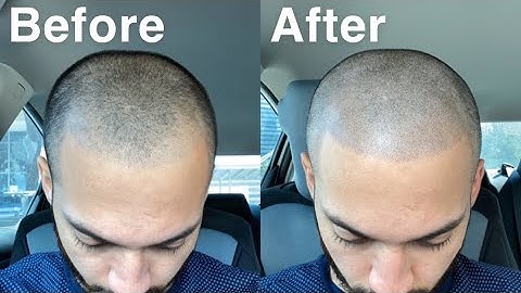 SMP (SCALP MICRO PIGMENTATION) SESSION NUMBER 2