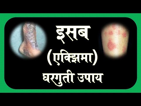 इसब - एक्झिमा - प्रभावी उपचार Eczema treatmnet