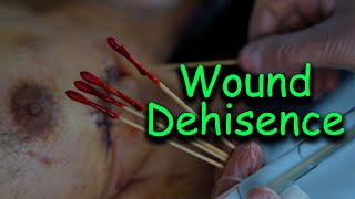 Draining an Abscess | تخلیه آبسه