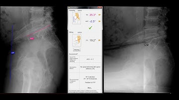 Spinopelvic Assessment Software for Total Hip Arthroplasty