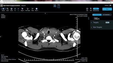 LesionTracker Demo (February 2017)