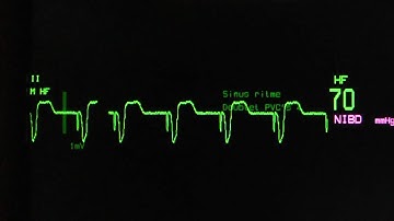 paced ventricular rhythm on an ECG monitor