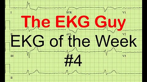 EKG/ECG of the Week #4 | The EKG Guy - www.ekg.md
