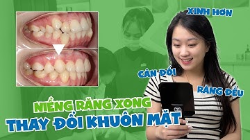 Sinh Viên Ngoại Giao Hoàn Thành Quá Trình Niềng Răng - Vlog Tháo Mắc Cài