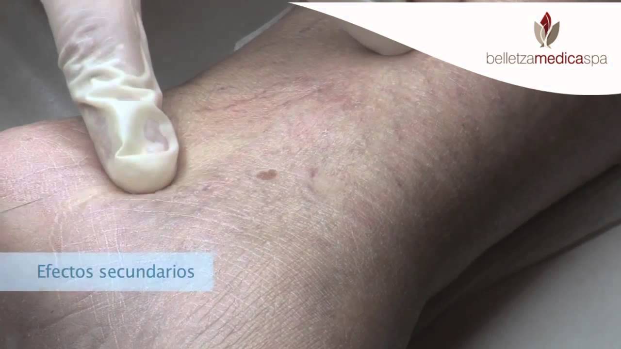 Varicosas eyaculación precoz venas